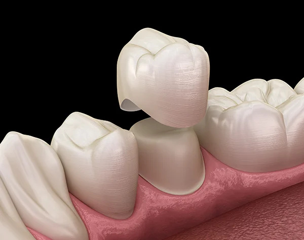  A 3D rendering of a dental crown being placed atop a tooth