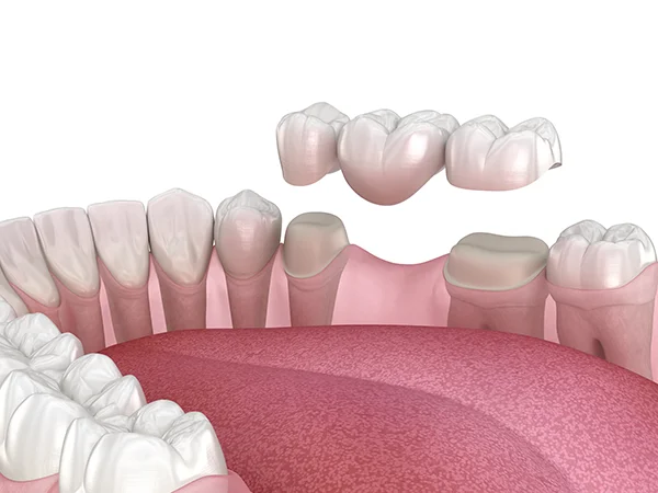 A 3D rendering of a dental bridge being placed on top of a missing tooth section